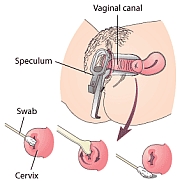 Womens health - Cervical Cancer
