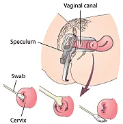 Women's health - Cervical Cancer